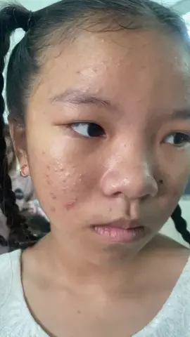 Bé mới có học lớp 4 mà da đả bị mụn đầu đen quá trời Chị e nào có con lớn tuổi dậy thì bị mụn thì điều trị sớm đừng để bị nặng thành sẹo rổ xấu da tộ