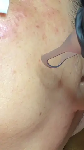 Laser bắn nám The Cici Spa Sóc Trăng. #laser