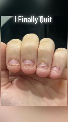 After 25 years of biting my nails due to anxiety and OCD i finally quit! 🙏🏼