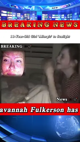 The girl suffers from a rare genetic disorder that causes her skin to burn in the sun. #News #foryou #usa #fyp 