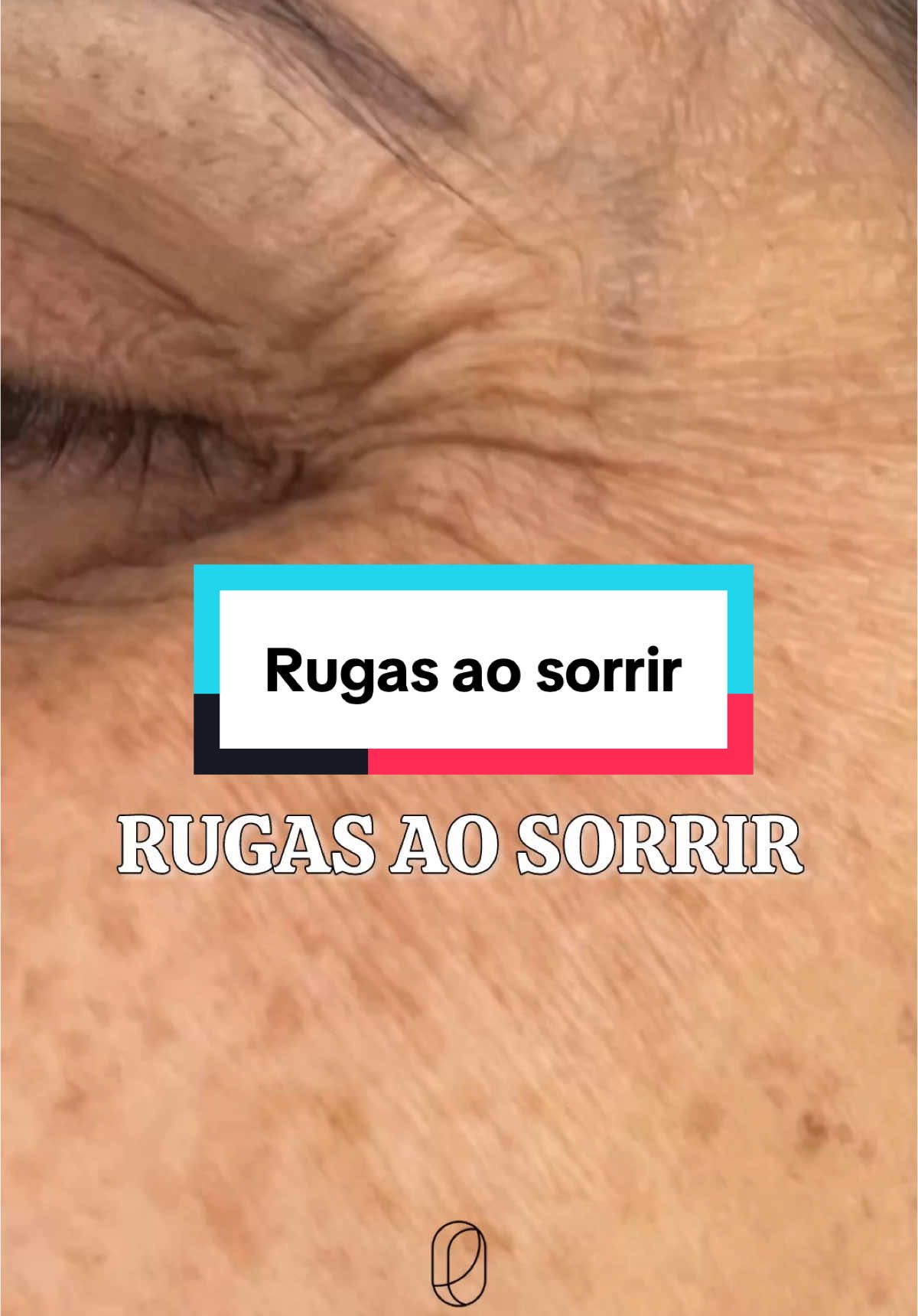 Essa ruga surge por causa da flacidez! A pele muito fina “dobra” com facilidade!  Isso não melhora somente com o botox!  Descubra como podemos melhorar a flacidez dessa pele tão delicada!  #dermato #dermatologia #dermatoembelem #dermatologist #dermatoembelém #dermatobelem #preenchimentofacial #preenchimento #preenchimentodemento #preenchimentodequeixo  __________________________ ✔ INFORMAÇÕES: 📞 Link para o nosso WhatsApp na bio ou (91) 98131-6663. 🏢Endereço: Av. Visconde de Souza Franco, 05 sala 1801 Ed. Quadra Corporate.