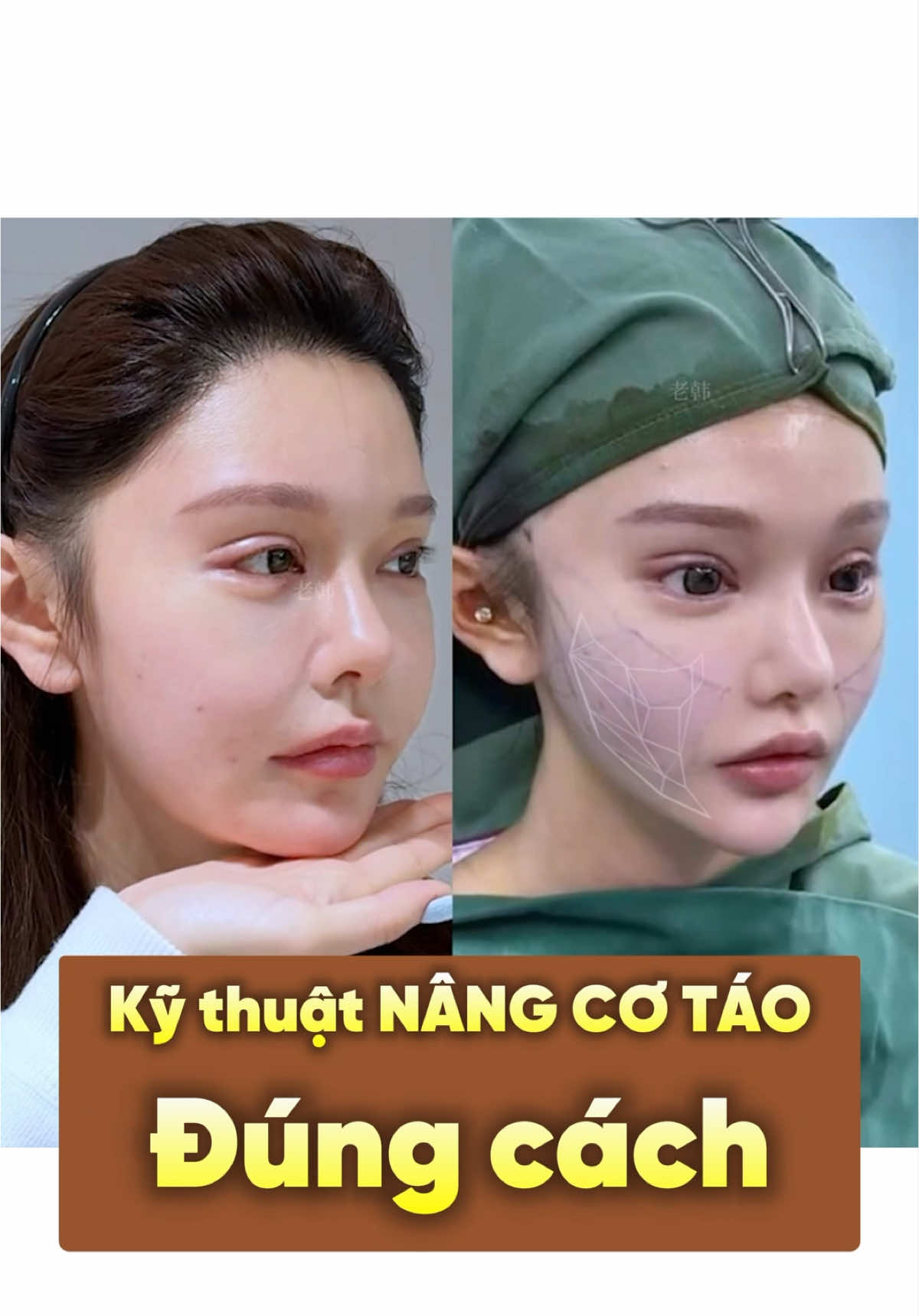 Kỹ thuật nâng cơ táo đúng cách??? #nangco #nangcomat #maidieulinh #thammy #phauthuatthammy #china #trungquoc #gaitrungquoc #dulichthammytrungquoc #dulichthammy #thuonghai #shanghai 