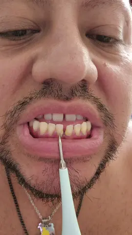 2 different vibration tools one that never worked and another one that removed all my visible tartar #tartar #ultrasonic #ultrasoniccleaner #plaque #dental #hygiene #teeth 