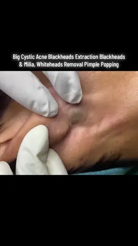 [Hana Spa & Clinic] Big Cystic Acne Blackheads Extraction Blackheads & Milia, Whiteheads Removal Pimple Popping (XAWjd1_E258)-1