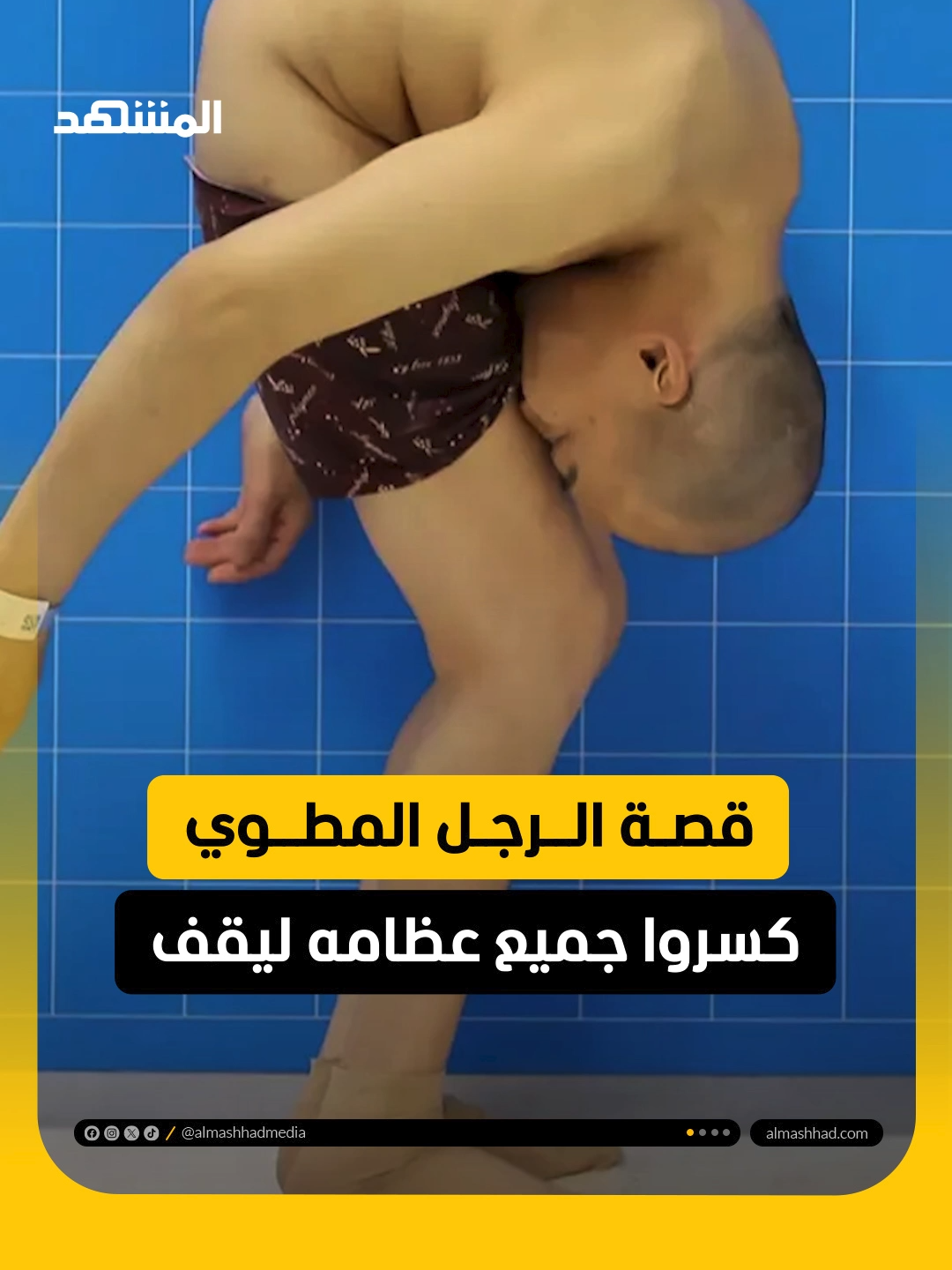 قصة الرجل المطوي.. كسروا جميع عظامه ليقف  طرقت أمه كل الأبواب لكن الجميع كان يجيبها بقسوة، ولدك ميؤوس منه وسيموت حتما، لكن طبيبا رأى زاوية أمل بأربع عمليات معقدة أعادت للصيني 