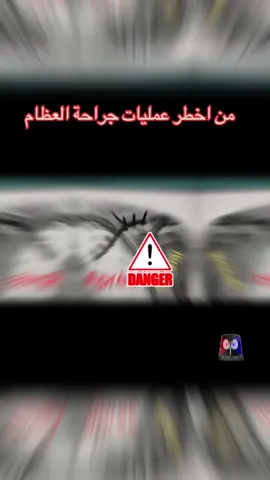 ##fractura #clavicular #falgerie🇩🇿_maroc🇲🇦_tunisie🇹🇳 #ora #chirurgie