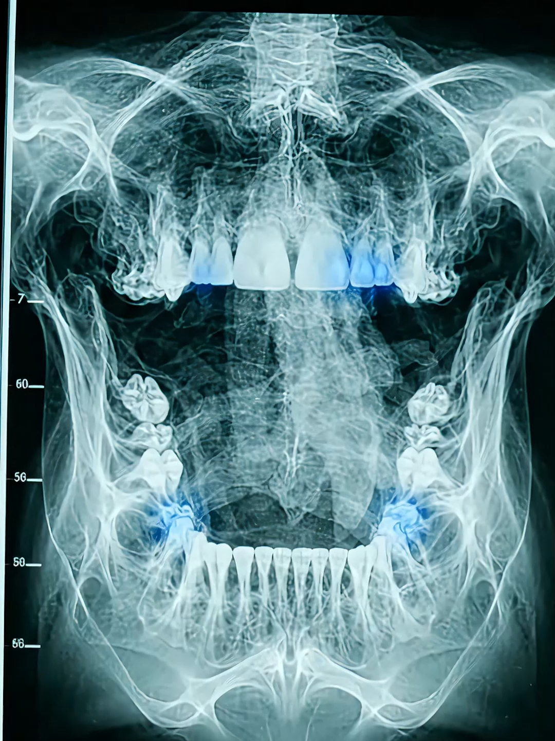 O seu dentista pode descobrir que você está com osteoporose antes do seu médico 🦴🦷 No raio-x panorâmico de rotina é possível identificar perda de densidade óssea muito antes de qualquer fratura. E a maioria das pessoas nunca soube disso. Segue para mais conteúdo de odontologia integrativa 👊 📱 Instagram: @drmarcus_barbosa #fyp #osteoporose #densidadeossea #saúdedamulher #saude #dentista #drmarcusbarbosa #odontologia #saude50mais #medtoker