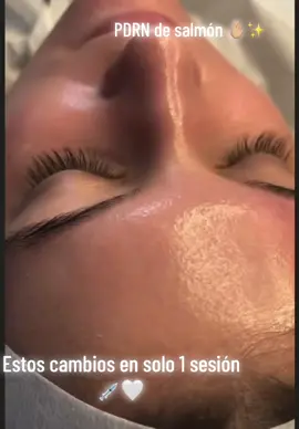 El secreto COREANO para una piel de porcelana y radiante ✨🫰🏼  PDRN DE SALMÓN 👆🤍 Es un ingrediente derivado del ADN 🧬 del salmón altamente biocompatible  con la piel humana 🧖🏽‍♀️ Beneficios:  *REGENERACION CELULAR (sanando el tejido dañado)  *Firmeza y Elasticidad (estimulación de colageno y elastina )  Ideal si tienes piel sensible o dañada por el sol, acné o tratamientos cosmético-agresivos. * HIDRATACIÓN PROFUNDA Efecto 