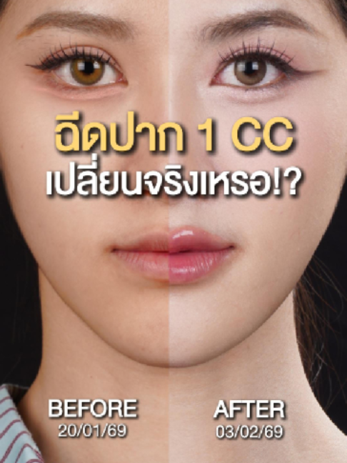 ฉีดปาก 1 CC เปลี่ยนจริงเหรอ!? #sowonclinic #ป้ายยาtiktok #รีวิวบิวตี้ #ฟิลเลอร์ #ติ้กต่อก #สวย #fyp #fypシ #viral #รีวิว #filler