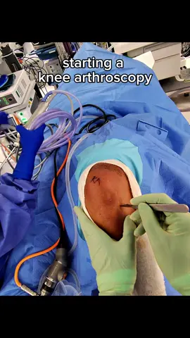 For most patients, this is a part of knee surgery they’ll never see. A small incision, an arthroscope into the joint, and we’re ready to look inside the knee. Next week, I’ll show you how we connect the camera and actually see what’s happening inside. Follow for more behind-the-scenes insights into knee surgery, sports injuries and recovery.