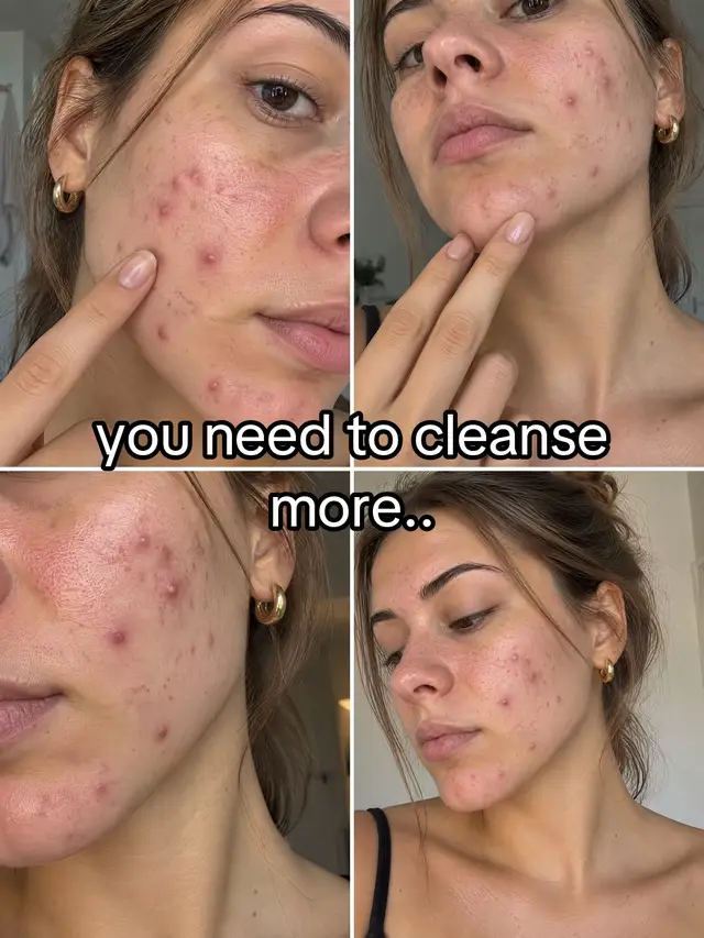 you actually need to follow me for daily tips🤍 #clearskin #baselit #skincaretips #acne
