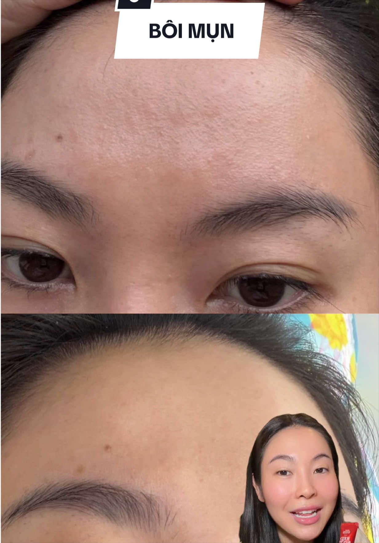 Cái gì có thể thua nhưng MỤN thì tự nhận có thể mình luôn thắng 😂 #chammun #chammunthuanchay #redspotcream #17hours #17hourshoptaccung 