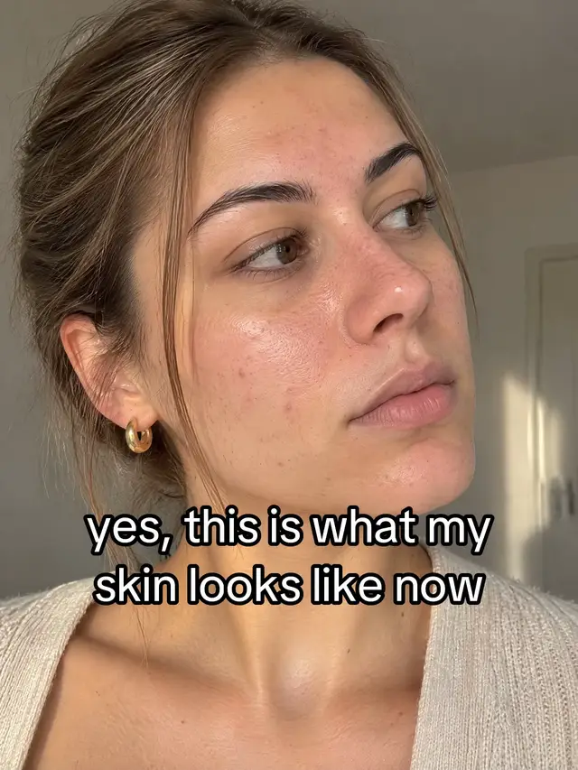🥹 #hormonalacne #acne #skincare #clearskin #baselit
