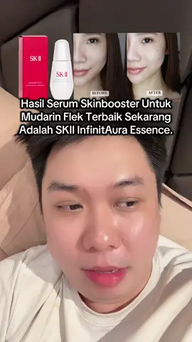 ini dari pendapat pribadi dan hasil pemakaian banyak sekali temen pejuang flek dan melasma kita yaa.. SKII InfinitAura + TXA hasilnya paling maksimal drpd breng skinbooster lainnya.. jadi buat yg perlu segeralah cicil2 buat coba #flek #melasma 