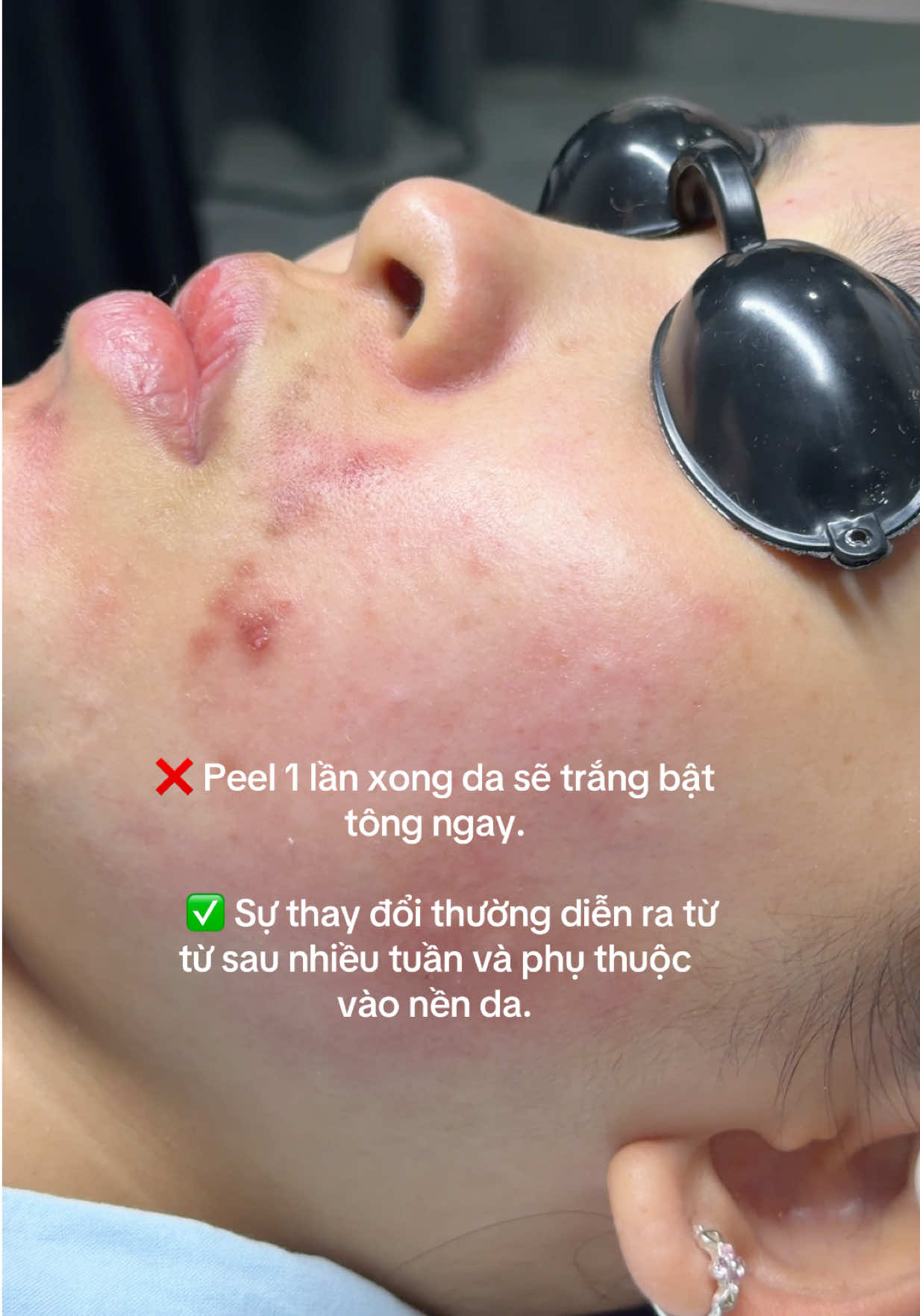 ❌ Peel 1 lần là da trắng bật tông, thâm biến mất hoàn toàn. ✅ Peel kết hợp bôi thoa đúng cách giúp tối ưu quá trình cải thiện thâm. Peel da hỗ trợ thúc đẩy tái tạo bề mặt, cải thiện tình trạng da xỉn màu và thâm sau mụn. Khi kết hợp cùng các hoạt chất bôi thoa phù hợp, quá trình cải thiện sắc tố có thể được hỗ trợ tốt hơn so với chỉ phụ thuộc vào một phương pháp. Tuy nhiên, thâm cần thời gian để cải thiện. Hiệu quả còn phụ thuộc vào tình trạng sắc tố, nền da và cách chăm sóc tại nhà. ✨ Không phải peel một lần là hết thâm, mà là kết hợp đúng phương pháp để da cải thiện tốt hơn qua từng giai đoạn. #BELADERM #peel #xuhuong #lamdep 