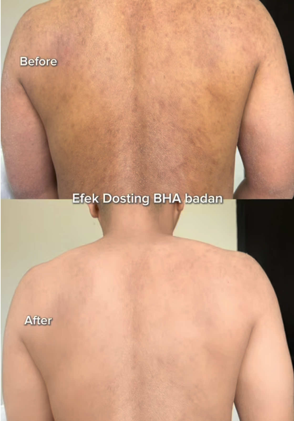 Nyobain ini dari beberapa minggu lalu GONG BGT emang ini produk! Catat Tanggal 20 Oktober Launchingnya #bodyserumg2g #jerawatpunggung #salycilicacid #BHA #bodyserum 