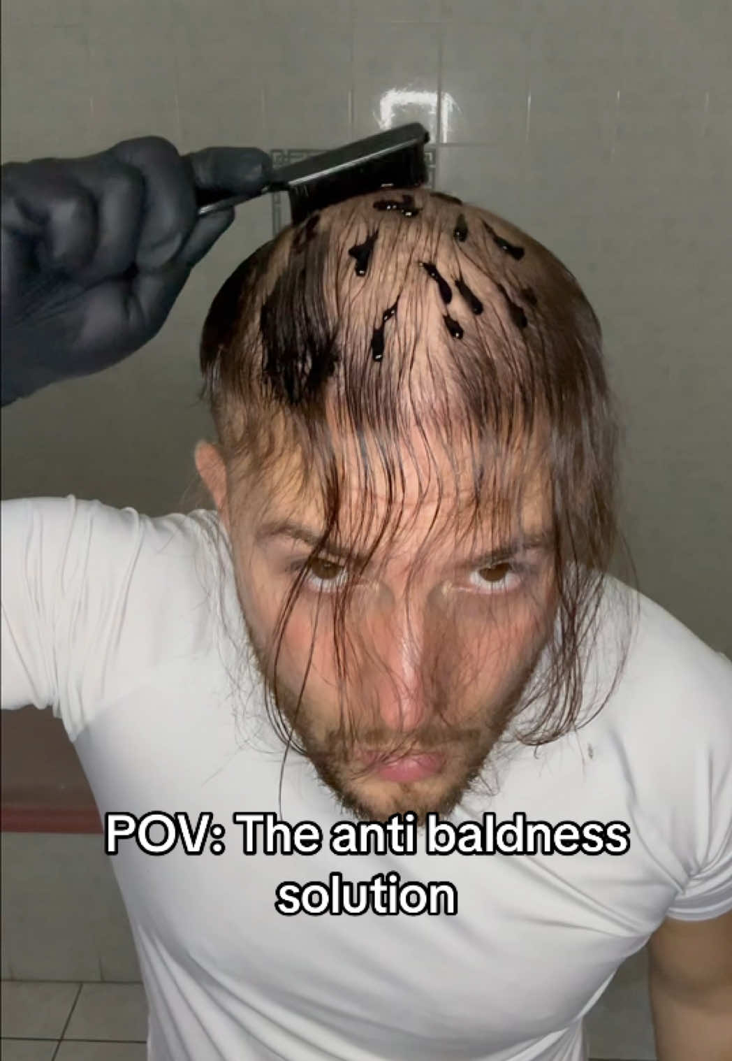 Miraj: The anti baldness solution