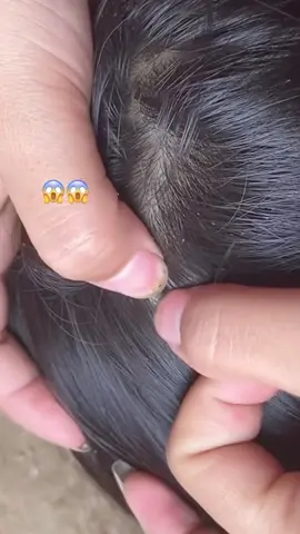 Lice Removal 😱😬💁#omg #lice #liceremoval #tiktokgrowthchallenge 