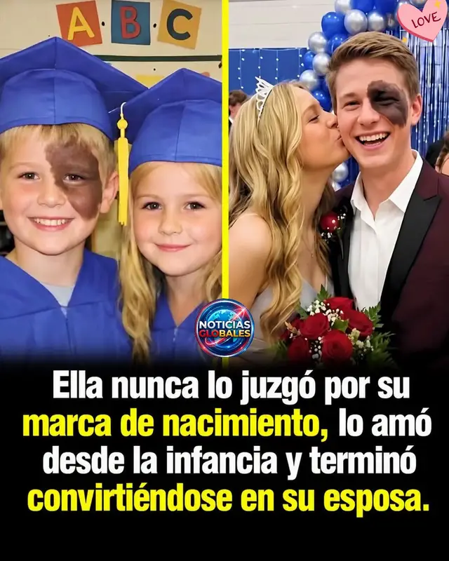 Ella vio más allá de su marca de nacimiento y lo eligió para toda la vida. Desde pequeños, el tenía una gran marca de nacimiento en el rostro, pero para ella eso nunca fue motivo para alejarse. La historia que acompaña estas fotografías cuenta que crecieron juntos y que aquella amistad de la infancia terminó convirtiéndose en una hermosa historia de amor. Con el paso de los años, los dos niños se habrían convertido en una pareja que decidió compartir su vida.  Lo más emotivo es que, mientras el tiempo cambió sus rostros, el cariño que los unía permaneció. Una historia que recuerda que el amor verdadero no se fija en las apariencias, sino en la persona que hay detras de ellas. Nota: No encontré una fuente confiable que confirme la identidad de la pareja ni que las fotografías sean auténticas. Por eso, la historia debe presentarse como un relato viral, no como un hecho comprobado. 