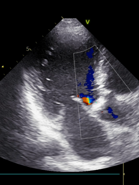 Decompensated critical combined AVD >St (AS 3 / AR 1) with gradients reduction & DCM phenotype // Декомпенсированный критический КАП 3 ст. >St (АС 3 / АН 1) с падением градиентов и фенотипом ДКМП.