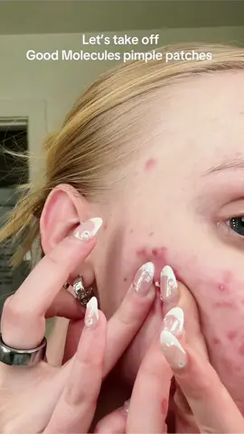 #acne #pimplepatch #pimplepatches #mouthtape  