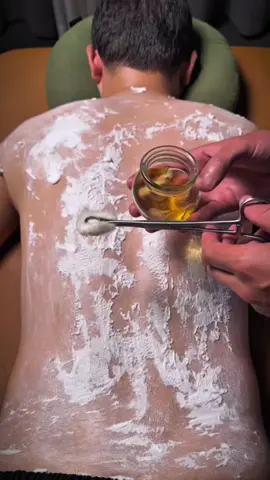 Cupping Therapy 😱  . . . #grow #asmr #fyp #viral #creatersearchingsight 